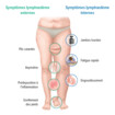 Les symptômes d'un lymphœdème