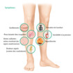 Symptômes thrombose veineuse profonde